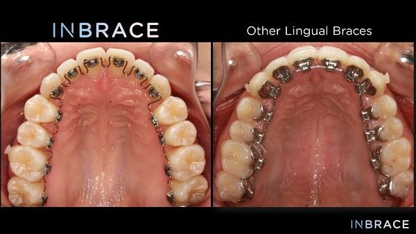 INBRACE Lingual Braces, District Orthodontics